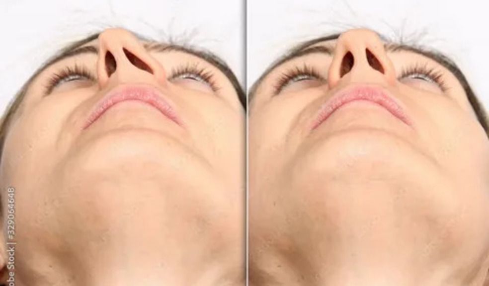 Best Septoplasty Surgeons in Dubai – Safe & Effective Care