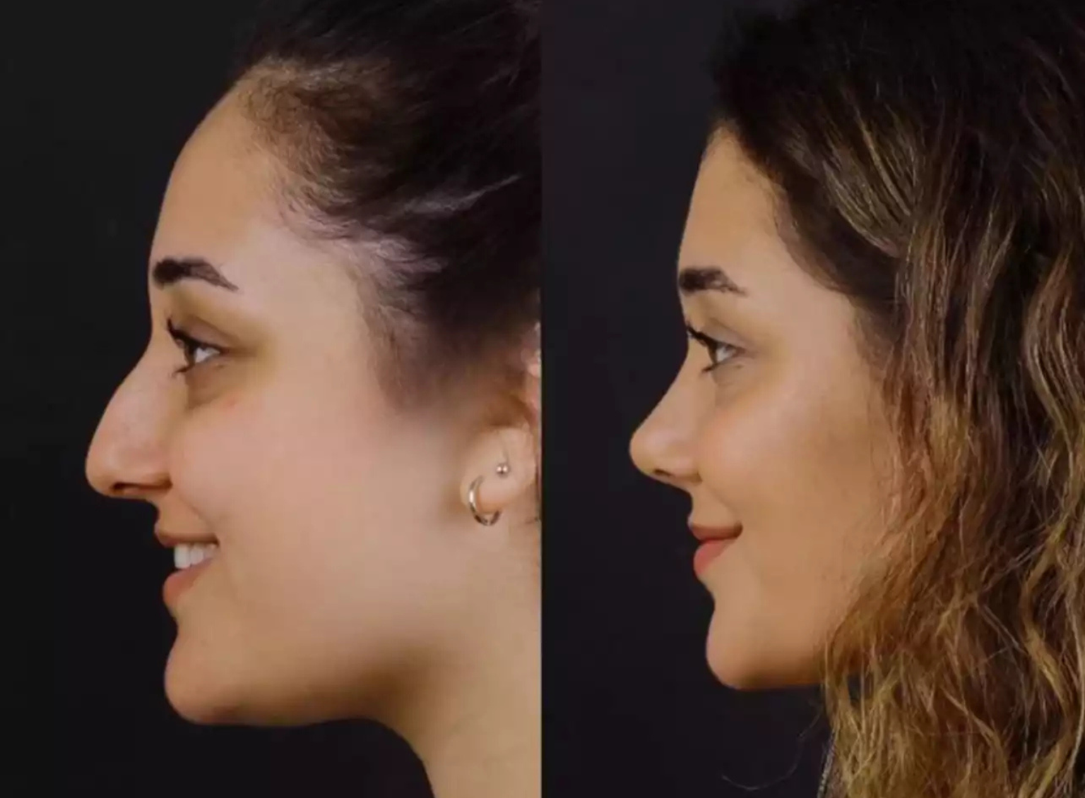 How Does the Best Septoplasty Surgeon in Dubai Compare to Others?