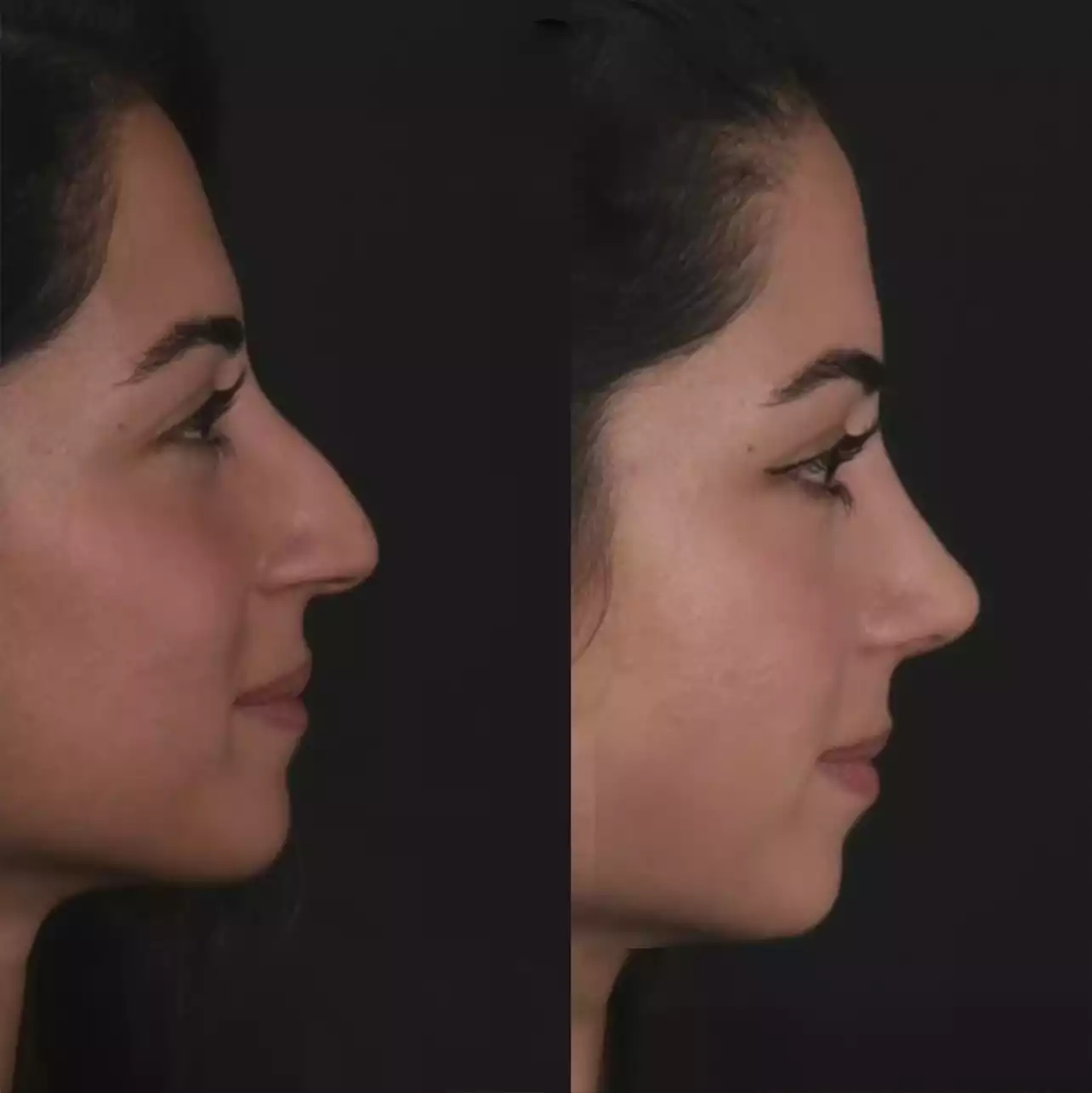 Top Signs You May Need Nose Deviated Septum Surgery in Dubai