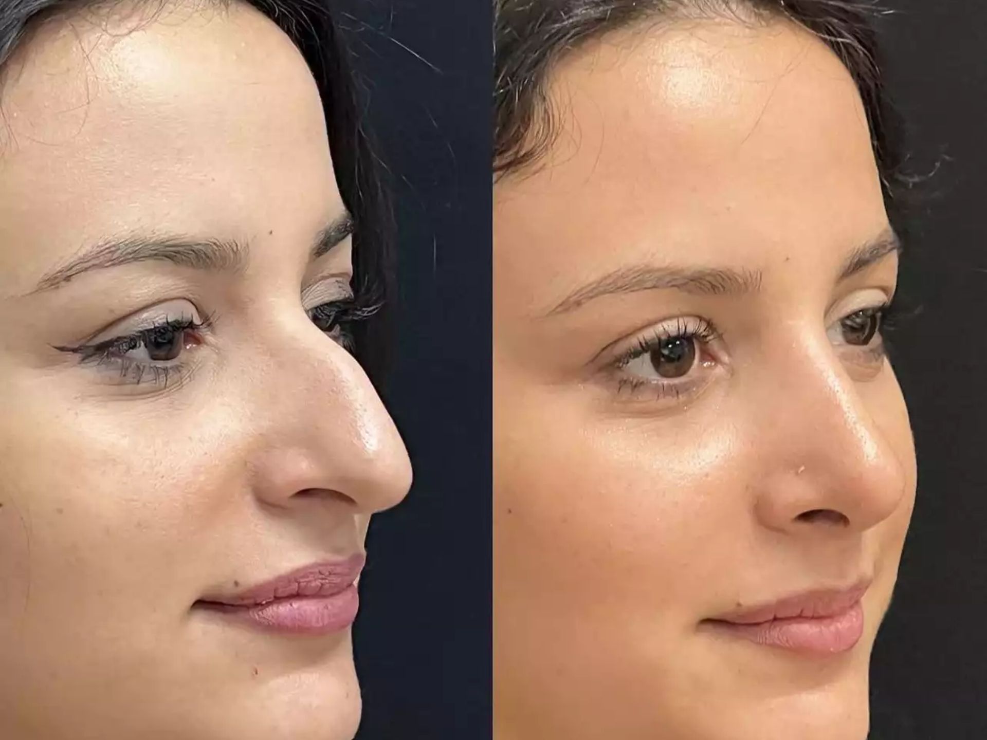 Best Rhinoplasty Surgeons in Dubai: Safe & Stunning Results