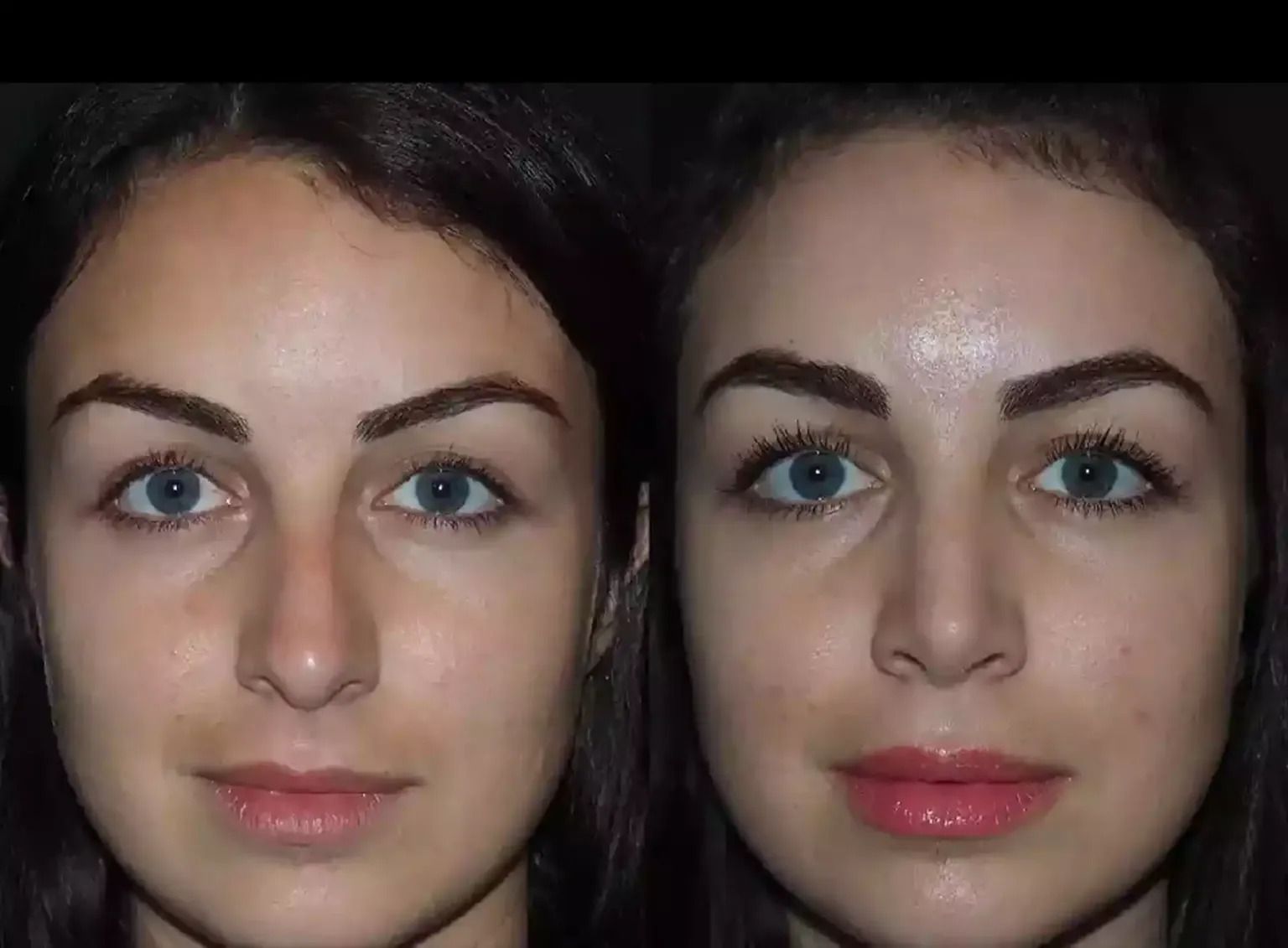 Best Septoplasty Surgeons in Dubai for Safe and Effective Results